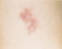birthmark__5new.jpg