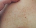 birthmark 1.JPG
